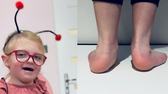 5-letnia Lenka potrzebuje operacji, by samodzielnie stawiać kroki